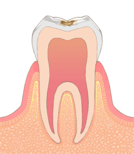 歯の表面の浅い虫歯