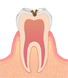 歯の中のやや深い虫歯