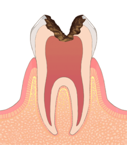 神経まで進行した深い虫歯