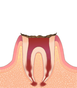 歯の根まで進行した虫歯