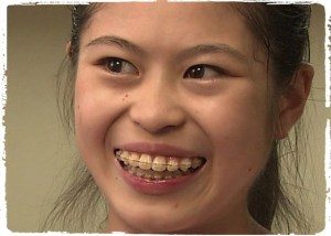 歯 列 矯正 顔 の 変化